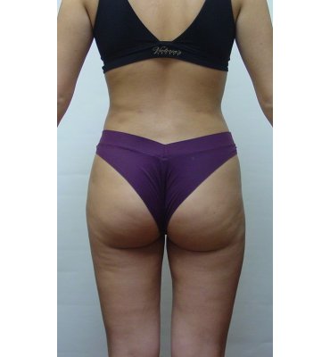 liposuction after